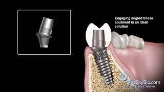 Engaging Angled Tibase [upl. by Taft]