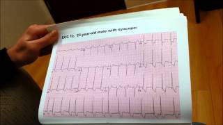 ekg13 25 YEAR OLD MALE WITH SYNCOPE wwwdrbenzurcom [upl. by Octavla]