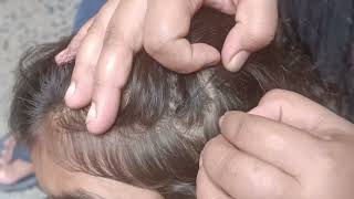 Worst of Head lice infestation in Young Girl ASMR Pakistan [upl. by Dnaltruoc]