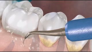 ¿Qué es la periodoncia y como tratarla I Clínica Dental Mas Bermejo Murcia [upl. by Akcemat]