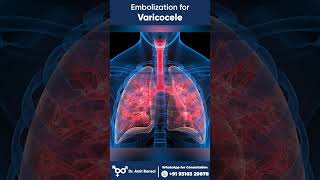 Varicocele I Varicocele Embolization I Embolization for Varicocele [upl. by Garibold]