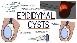 Understanding Epididymal Cysts [upl. by Hareehat953]