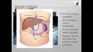 Цирроз  Элэгний хатуурал [upl. by Moscow]