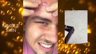 30 minutes of Pimple Popping Compilation [upl. by Mairam543]