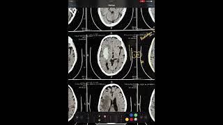 CT BRAIN  PUTAMEN BLEED  BASAL GANGLIA HEMORRHAGE TYPICAL HYPERTENSIVE BLEED HEMORRHAGE [upl. by Medardas]