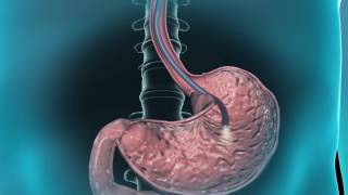 Learn about gastroscopy [upl. by Lipps]