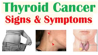 Thyroid Cancer Signs amp Symptoms amp Why They Occur [upl. by Esmeralda]