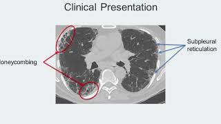 Honeycombing Track H Stop 3 IPF Navigating a Complex Disease [upl. by Changaris]