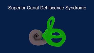 Superior Canal Dehiscence Syndrome SCDS [upl. by Leahicm]