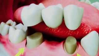 Dental Bridges  How to properly clean your teeth [upl. by Maise]