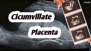 Circumvallate placenta on ultrasoundplacental abnormalities [upl. by Christan]