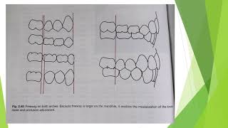 Orthodontics  Cast Analysis  Part 3 ALD  Mixed Dentition Analysis  Bolton Analysis [upl. by Atnohsal942]