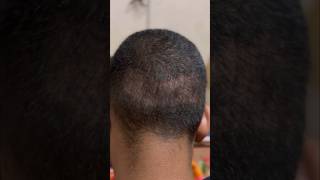 Donor area result  youtubeshorts minivlog hairstyle trending donorhair hairlinetransplant [upl. by Sergias]