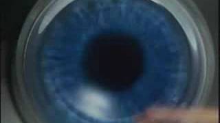 LasikPlus Intralase® Bladeless LASIK Procedure AllLaser Lasik [upl. by Neerod]