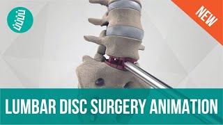 Lumbar Disc Replacement with 3rdGen Technology [upl. by Gujral]