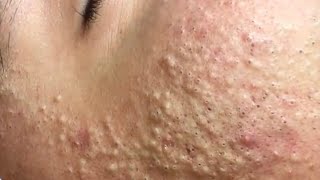 Huyen phan treantment acne 111 acne mun nanmun treatment trending [upl. by Maddocks]