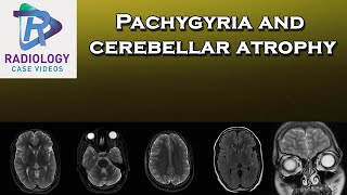 Pachygyria and cerebellar atrophy [upl. by Nahtaoj]