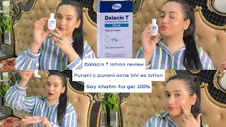 Dalacin T Lotion Review Bye bye Acne 😡 say Hi to new skin❤️Best Acne lotion 100 guaranteed results [upl. by Kyriako]