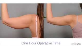 Get Firm Sculpted Arms With Smartlipo™  Dr Sterry Explains [upl. by Dihgirb]