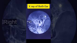 XRay Of Both EarSchuller Views [upl. by Robi411]