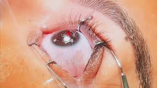 Eye Surgery  laser eye surgery  lasik eye surgery [upl. by Gusba]