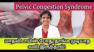 மாதவிடாயின் போது தாங்க முடியாத வலி Pelvic congestion syndrome அறிகுறி  DrJagadeeswariRajalingam [upl. by Dianthe416]