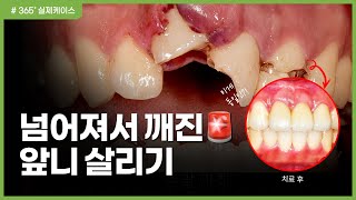 킥보드 타다 넘어져 깨진 앞니 빼야 할까 교정과 보철과 보존과 치주과 전문의 협진으로 멀쩡히 살려낸 이야기  다친치아 살리기 실제과정  전문의치과  전문의협진치과 [upl. by Ilek664]