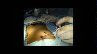 e TEP repair of a direct and a femoral hernia [upl. by Casmey]