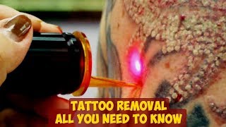 Tattoo Removal ► All You Need To Know [upl. by Limak]