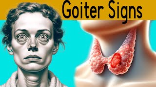 Goiter explained under 3 minutes Causes Symptoms Treatment [upl. by Neelyaj]