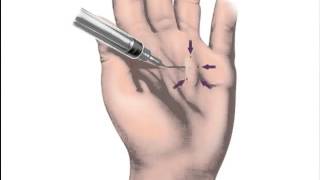 NonSurgical Treatment of Dupuytrens Contracture Brian Fingado MD Orthopedic Hand Specialist [upl. by Obaza]