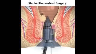 Stapled Hemorrhoids Surgery  Jyoti Nursing Home  Best Piles Hospital In Jaipur [upl. by Gomez881]