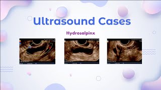 Hydrosalpinx  Ultrasound Cases [upl. by Adnahsat]