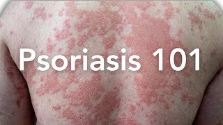 EVERYTHING to Know About Psoriasis  Dermatologist Explains [upl. by Lareneg656]