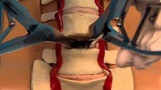 Synthes Spine ProDiscL Lumbar Total Disc Replacement Demonstration Video [upl. by Daugherty]