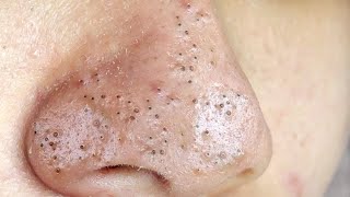 Big Cystic Acne Blackheads Extraction Blackheads amp Milia Whiteheads Removal Pimple Popping  5233 [upl. by Watkins]