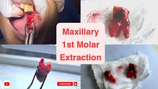 Maxillary first molar  Upper 1st molar extraction youtube dentistry dentist trending [upl. by Monique298]