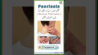 Psoriasis  Severe Condition Symptoms and Treatment in UrduHindi medicine skincare shortvideo [upl. by Ettigdirb]