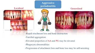 Classification of periodontitis [upl. by Azitram]