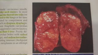 Medullary Thyroid Carcinoma  SPECIAL PATHOLOGY [upl. by Festus249]