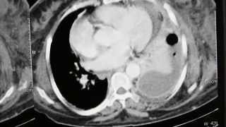 Left multiloculated empyema in lungs CT chest [upl. by Archie]