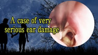 In case of serious ear damage Ear fungus ear infection perforated eardrum [upl. by Magnolia242]