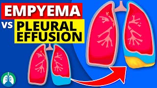 Empyema vs Pleural Effusion EXPLAINED [upl. by Ahsenroc]