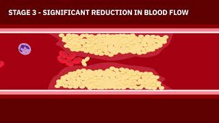 Coronary Artery Disease Animation [upl. by Bullis]