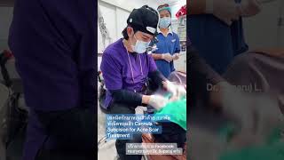 เทคนิครักษาหลุมสิวด้วย การตัดพังผืดหลุมสิว Cannula Subcision for Acne Scar Treatment [upl. by Hpejsoj]