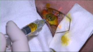 Epitheliumon cornea collagen cross linking for keratoconus [upl. by Ynafets]