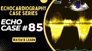 Echocardiography Case 85  Echo Case Series  Echocardiogram Interpretation made easy for Beginners [upl. by Iphigenia]