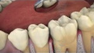 The Role of ARESTIN® in Periodontal Treatment [upl. by Arutak]