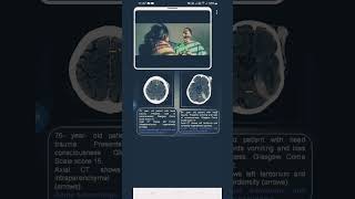 contusion vs subduralhematoma [upl. by Kusin966]