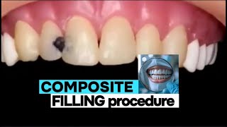 Tooth filling procedure  tooth filling cavity  dental filling procedure dentist ndc [upl. by Niletak898]